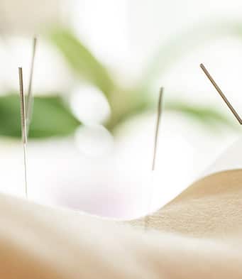 acupuncture