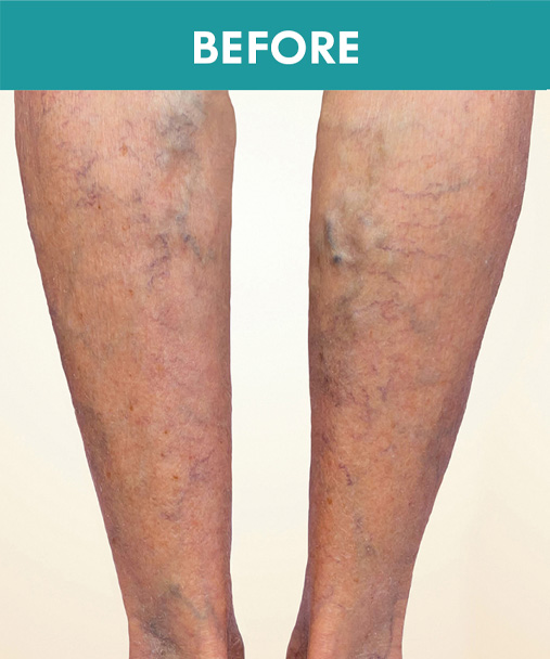 Legs Before